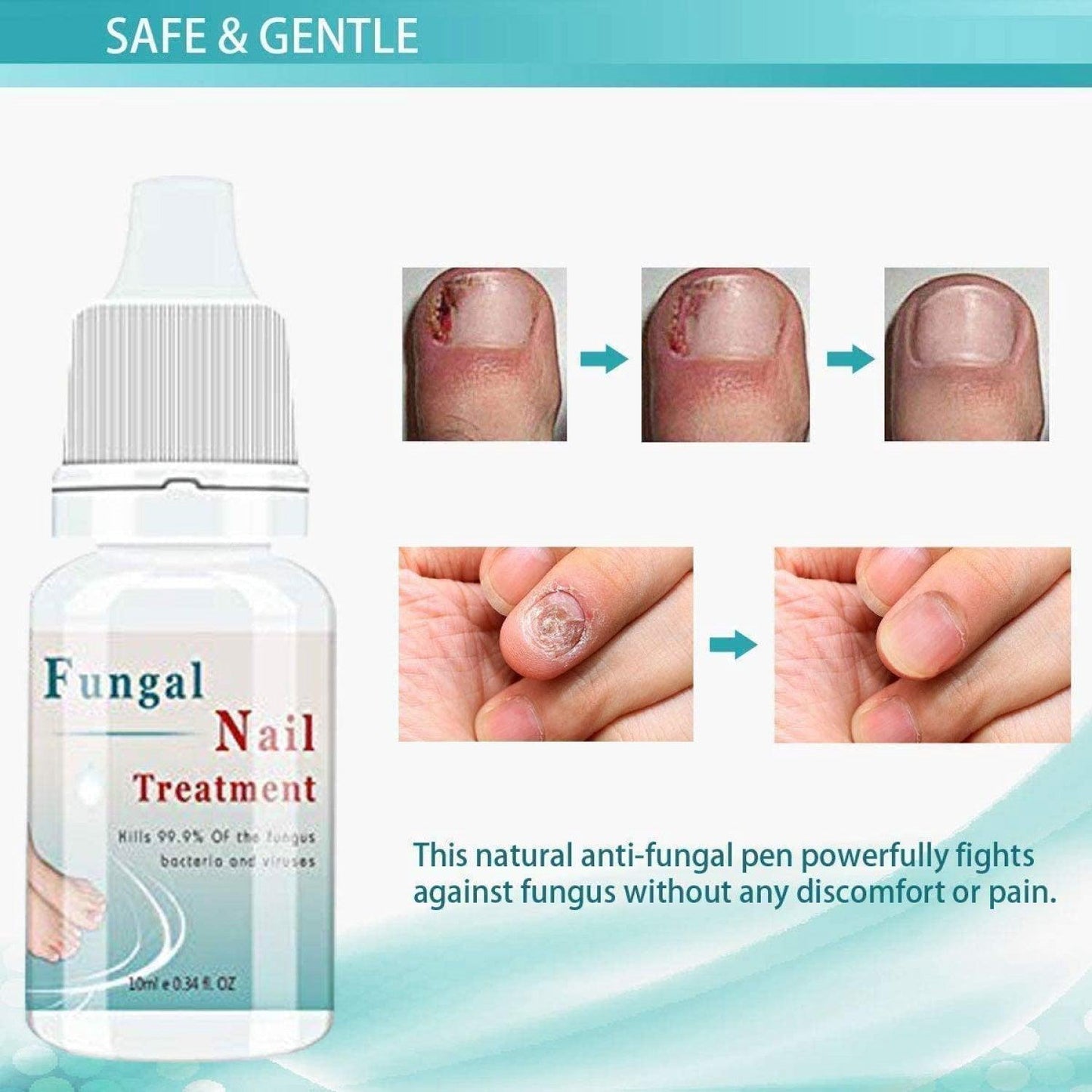 Fungal Nail Treatment - 10ml Liquid Highly Effective Kills Toenail Fungus