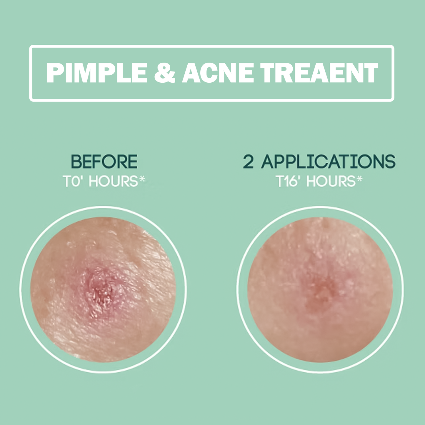 Hydrocolloid Pimple Patches – Dots for Spots Acne Patch | Pack of 24 Korean Skincare Spot Stickers