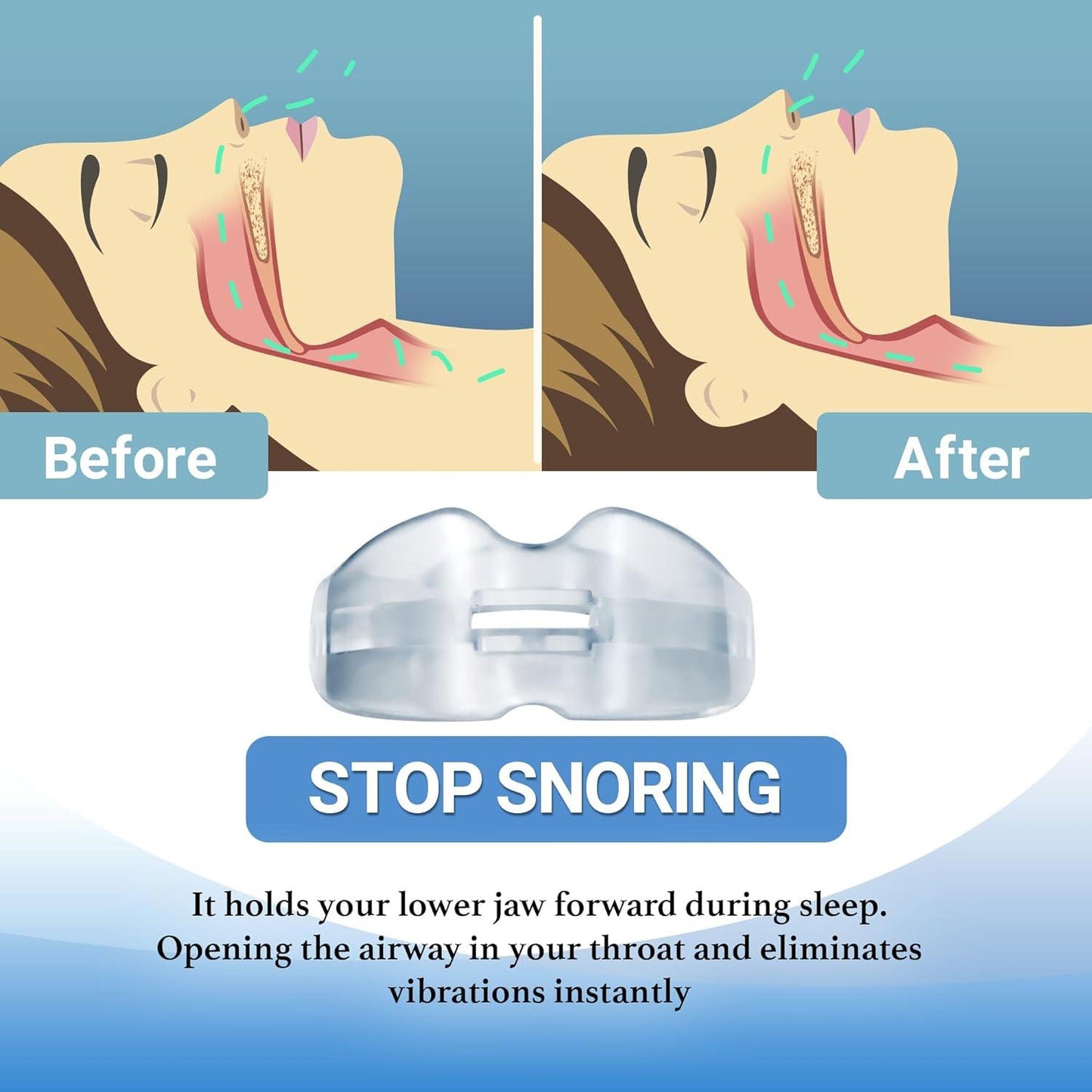 Mouthguard for Snoring - NHS Snore Stopper Anti Snoring Mouth Guard Device Sleep Aid Stop Apnoea
