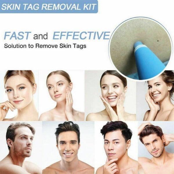 Skin Tag Removal Kit - Natural Painless Auto SKIN TAG Removal Skin tag bands Remover Device