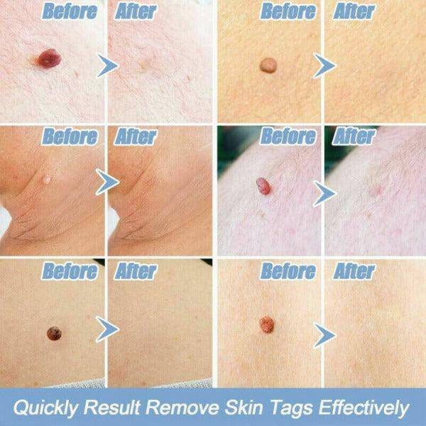 Skin Tag Removal Kit - Natural Painless Auto SKIN TAG Removal Skin tag bands Remover Device