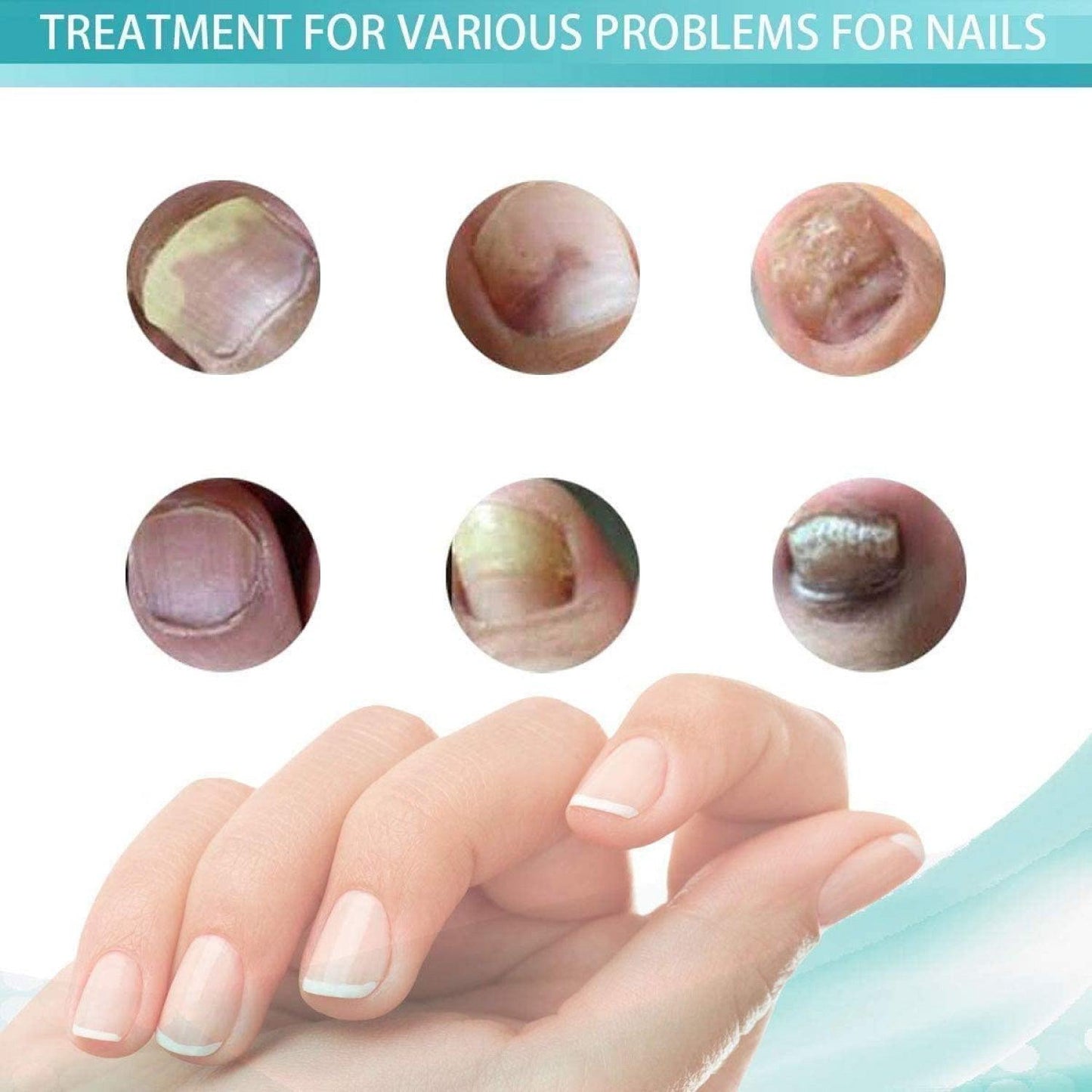 Fungal Nail Treatment - 10ml Liquid Highly Effective Kills Toenail Fungus