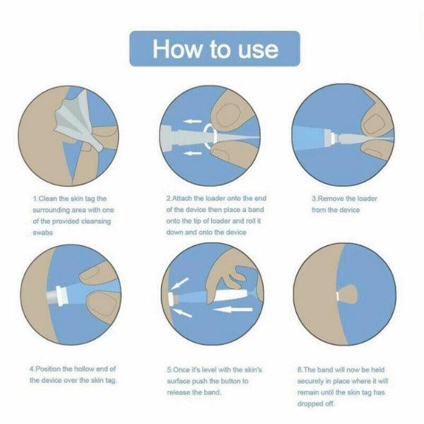 Skin Tag Removal Kit - Natural Painless Auto SKIN TAG Removal Skin tag bands Remover Device