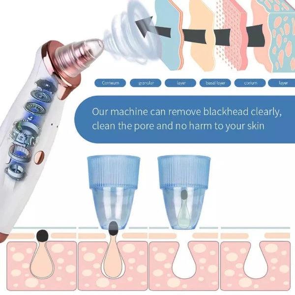 Best Blackhead Remover Vacuum - Professional Pore Cleaner Vacuum Blackhead Remover Rechargeable 5 Suction Levels