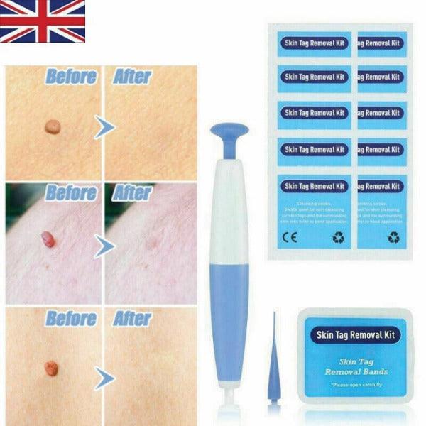 Skin Tag Removal Kit - Natural Painless Auto SKIN TAG Removal Skin tag bands Remover Device